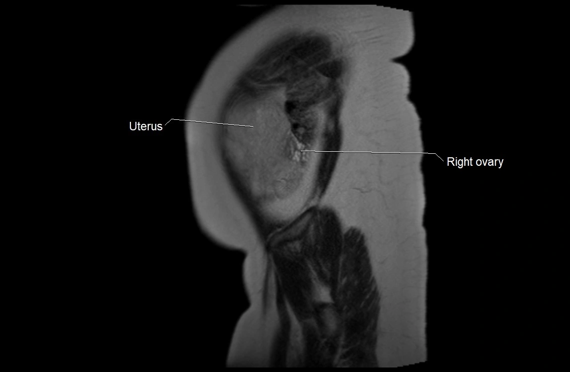 MRI fetal anatomy sagittal image 2.webp
